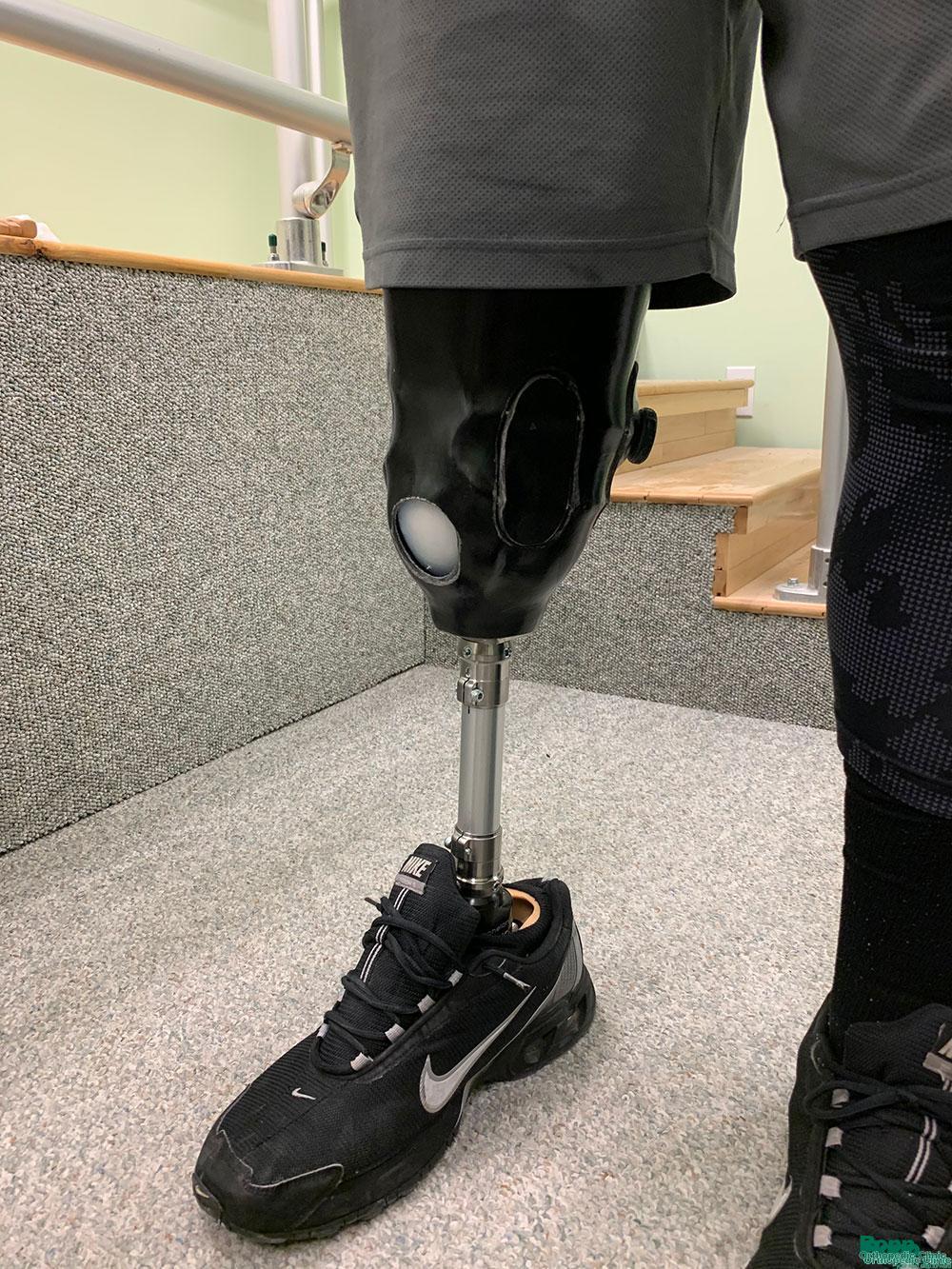 Custom Hi-Fidelity Below Knee Prosthetic